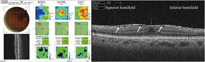 Effect of idiopathic epiretinal membrane on macular ganglion cell complex measurement in eyes with glaucoma